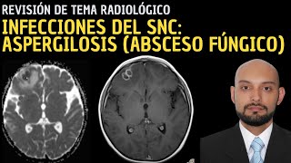 Radiología en 5 minutos Infecciones del sistema nervioso central Aspergilosis absceso fúngico [upl. by Kotta690]