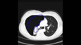 Pneumothorax due to lymphangioleiomyomatosis [upl. by Diahann589]