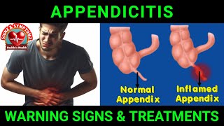 Appendicitis Symptoms and Treatment Options appendicitis [upl. by Meensat948]