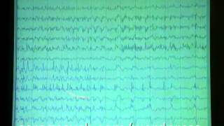 Long term monitored EEG [upl. by Antonina79]