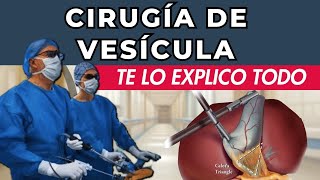 CIRUGÍA DE VESÍCULA  Colecistectomía Laparoscópica  Lo que debes saber [upl. by Enixam]