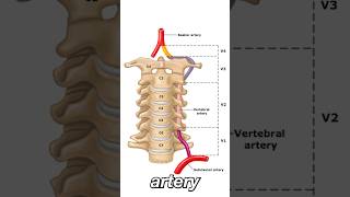 Vertebral Artery Dissection [upl. by Hyams]