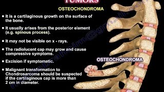 Aneurysmal Bone Cyst [upl. by Hagar]