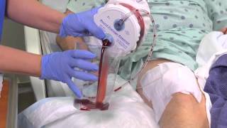 closed wound drainage system video [upl. by Aneelahs775]