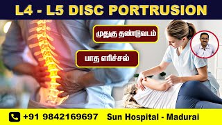 L4 L5 DISC PROTRUSION  Severe Backpain  Burning Sensation  Recovery  Sun Hospital  Madurai [upl. by Idnak949]