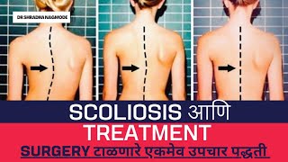 Avoid Surgery in Scoliosis  physiotherapy treatment  Spine Caredrshradhanagmode6173 [upl. by Seaman117]