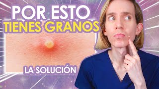 5 RAZONES por las cuales TE SALEN GRANITOS  Como SOLUCIONARLAS  Simon Scarano Dermatologo [upl. by Dorin637]