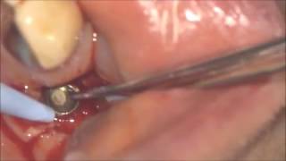 How to Remove Fractured AstraTech Abutment ScrewM2 [upl. by Gnagflow]