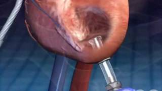 Left Ventricular Assistive Device  3D Medical Animation  ABP © [upl. by Nirrac]