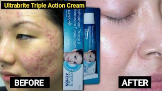 ultrabrite skin Cream uses in hindi  ultrabrite skin Cream side effects  ultrabrite Cream review [upl. by Bocoj214]