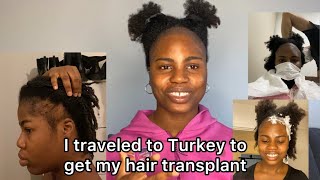 Cure for balding edges  FUE hair Transplant for Black women afro hair  Longevita Turkey [upl. by Relyks]