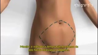 Abdominoplastia Explicada  Plástica do Abdome RJ [upl. by Llenrod]