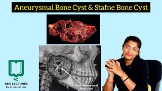 Aneurysmal Bone Cyst  Stafne Bone Cyst  Lecture 18  Oral Pathology [upl. by Chaffee]