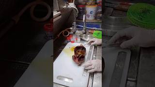 ovarian cyst cyst histopathology [upl. by Rafa300]