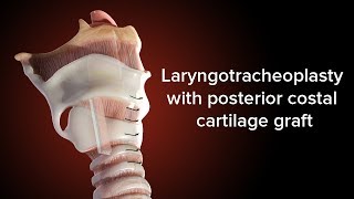 Medical Animation Posterior Cricoid Split  Cincinnati Childrens [upl. by Ellenahc]