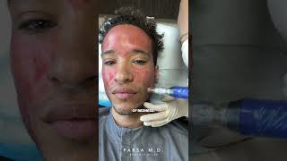 Microneedling with PRP for Acne Scars  Kami Parsa MD skincare acnescars [upl. by Bibbye912]