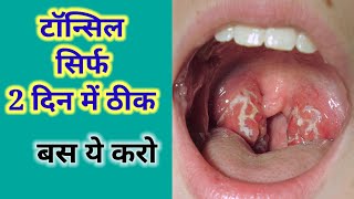 टॉन्सिल सिर्फ 2 दिन में ठीकTonsil ko kaise thik karenTonsil treatmentTonsil ka ilaj [upl. by Eniad]