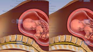 Premature Rupture of the Membranes [upl. by Colette]