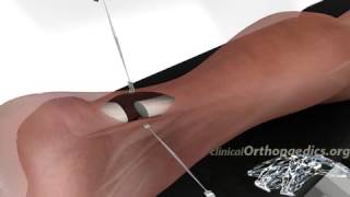 Surgical repair of a ruptured Achilles tendon [upl. by Irehj]