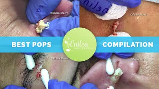 Enilsas Top 5 Best Cyst Popping Compilation [upl. by Ydda]