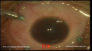 Punctum plug for Optic Disc Pit  No Myths Real Life Surgery Technique [upl. by Nishom]