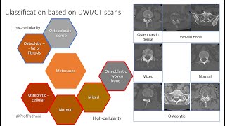 Multiparametric Imaging Patterns of Untreated Bone Metastases [upl. by Atiram]