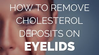 How to remove cholesterol deposits on eyelids Fast [upl. by Kelcey]