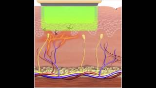 How IPL  Photorejuvenation works for Vascular Lesions [upl. by Esnahc439]