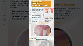 Bicornuate Uterus Laparoscopy  Dr Divya  Kanchipuram  EMMESS [upl. by Nehpets]