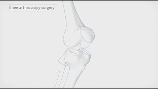 How a knee arthroscopy is performed  Spire Healthcare [upl. by Reffinej57]