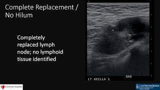 Approach To Axillary Lymph Nodes [upl. by Eerihs]