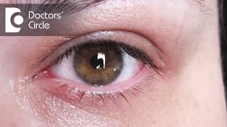 How to treat eye redness amp pain  Dr Sriram Ramalingam [upl. by Sandro965]