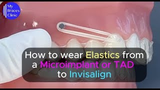 How to wear Elastics from a microimplant or TAD to Invisalign [upl. by Ardnosal]