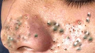 Big Cystic Acne Blackheads Extraction Blackheads amp Milia Whiteheads Removal Pimple Popping  9014 [upl. by Naashom]