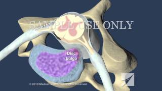 Cervical Disc Herniation [upl. by Aryahay]