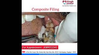 Composite Filling [upl. by Ib]