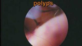 Endometrial polyp in a young nulliparous women [upl. by Gorrian]