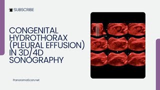 Fetal Hydrothorax [upl. by Curcio]