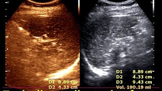 Granulomatous lesions of the spleen  Practical Ultrasonogram Spleen  Lymphoma Spleen [upl. by Arorua]