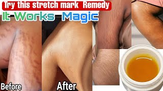 Effective way to clear STRETCH MARKS FASTER Remove Stretch marks very fast stretchmarksremoval [upl. by Langan]