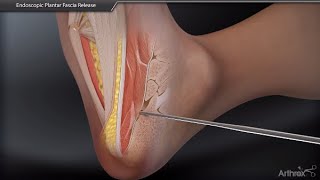 Endoscopic Plantar Fascia Release [upl. by Lon193]