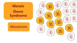 Mosaic Down Syndrome  Mosaicism  A type of Down Syndrome [upl. by Nuajed847]