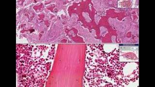 Histopathology BonePaget disease [upl. by Relyuhcs]