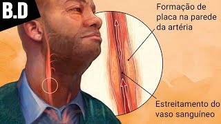 ATEROSCLEROSE – Sintomas Prevenção e Tratamento  Biologia com Patrick Gomes [upl. by Porett970]