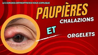 Comment soigner un chalazion  un Orgelet  Tu risques d’être surpris Maladie des paupières [upl. by Hawthorn996]