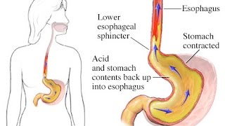 Gastroesophageal Reflux Disease GERD [upl. by Ataynik]