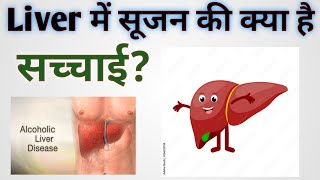 Liver में सूजन की क्या है सच्चाई Hepatomegaly causes symptomsdiagnosis [upl. by Lucille]