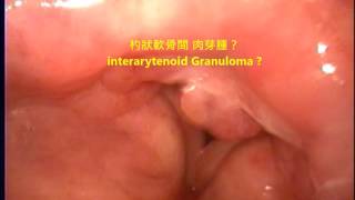 口咽癌 喉部杓狀軟骨間 肉芽腫 interarytenoid granuloma oropharyngeal cancer cancer post op radiotherapy [upl. by Ajam]