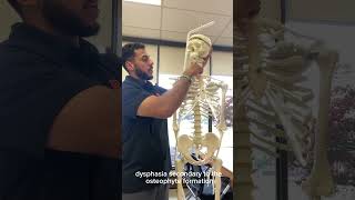 Diffuse Idiopathic Skeletal Hyperostosis and Physical Therapy [upl. by Sailesh]