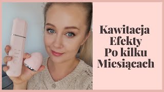 Domowa Kawitacja Efekty Po Kilku Miesiącach [upl. by Rosabel933]